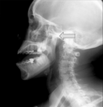 X-ray TM Joints LAT